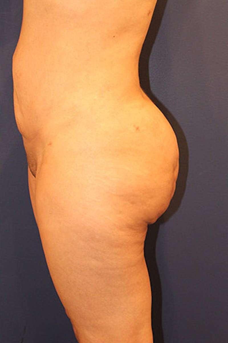 Liposuction Before & After