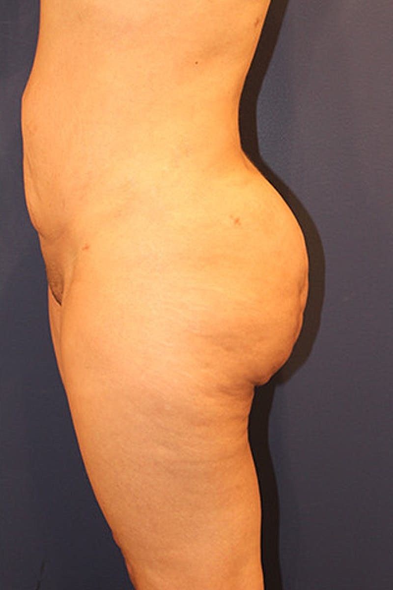 Liposuction Before & After