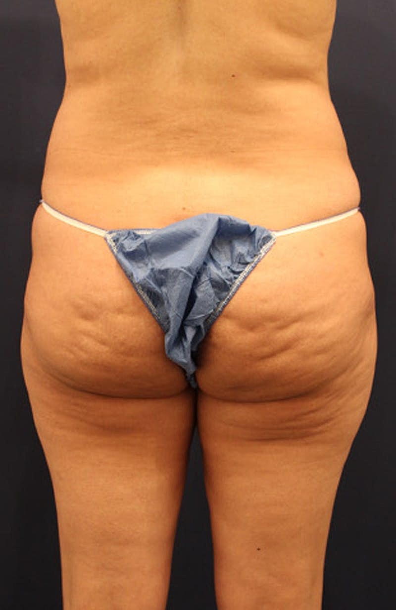 Liposuction Before & After
