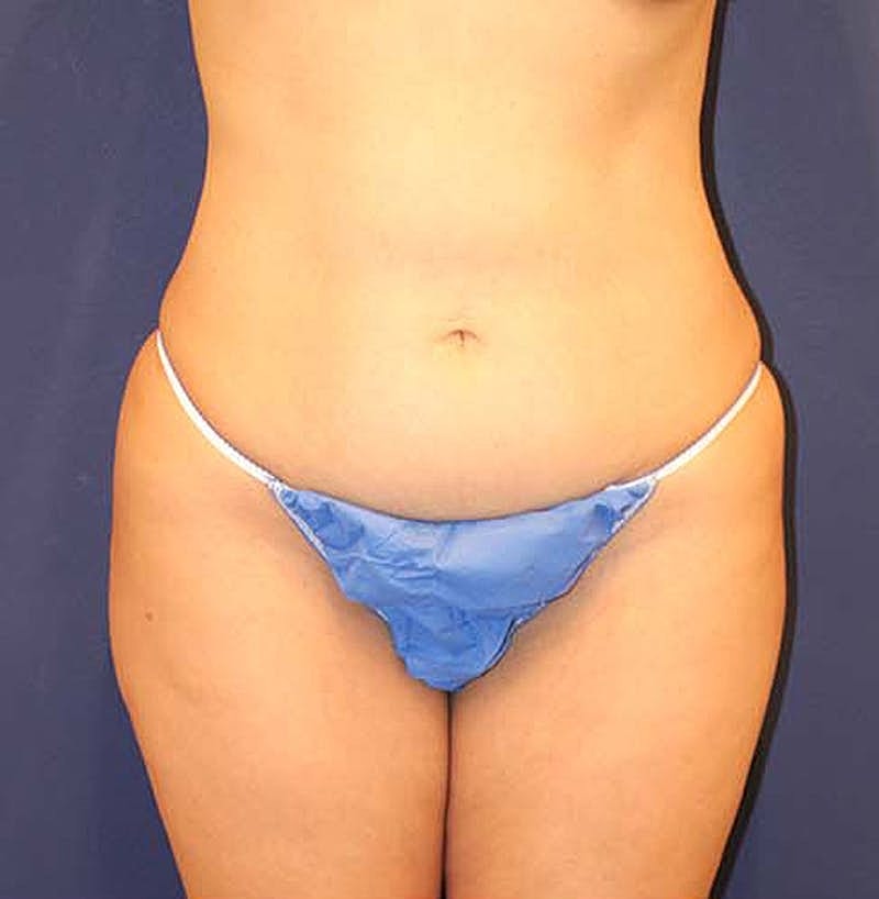 Liposuction Before & After