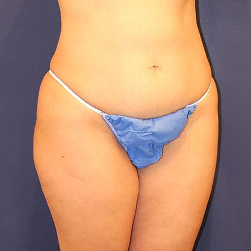 Liposuction Before & After
