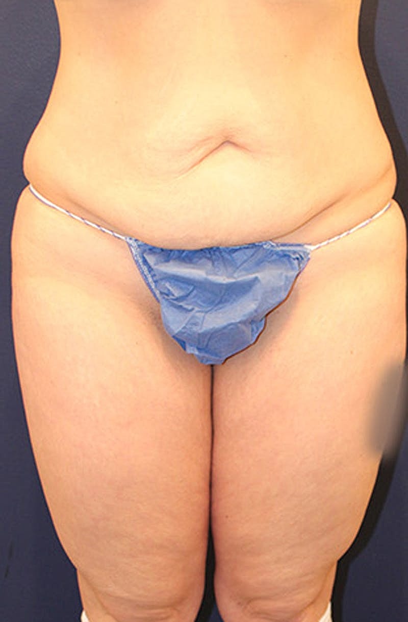 Liposuction Before & After