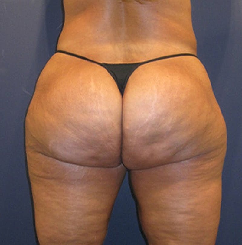 Liposuction Before & After