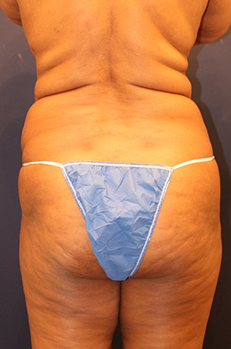 Liposuction Before & After