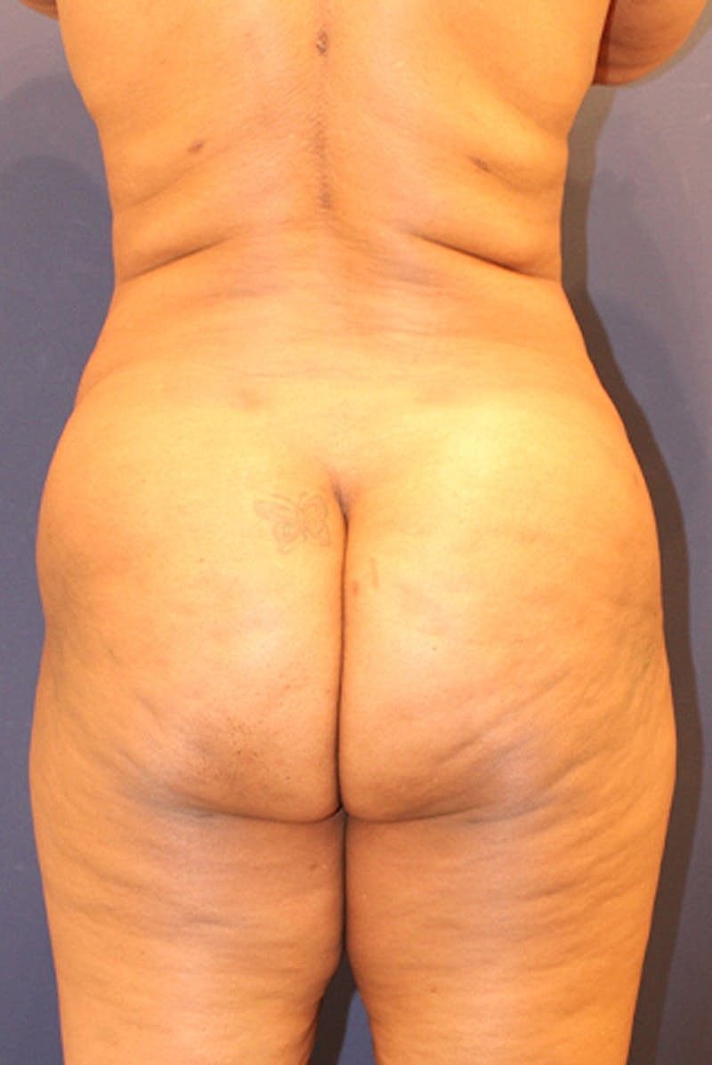 Liposuction Before & After