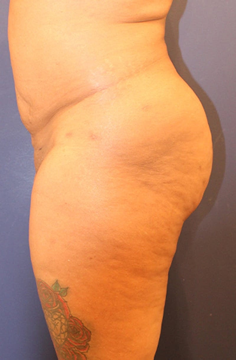 Liposuction Before & After