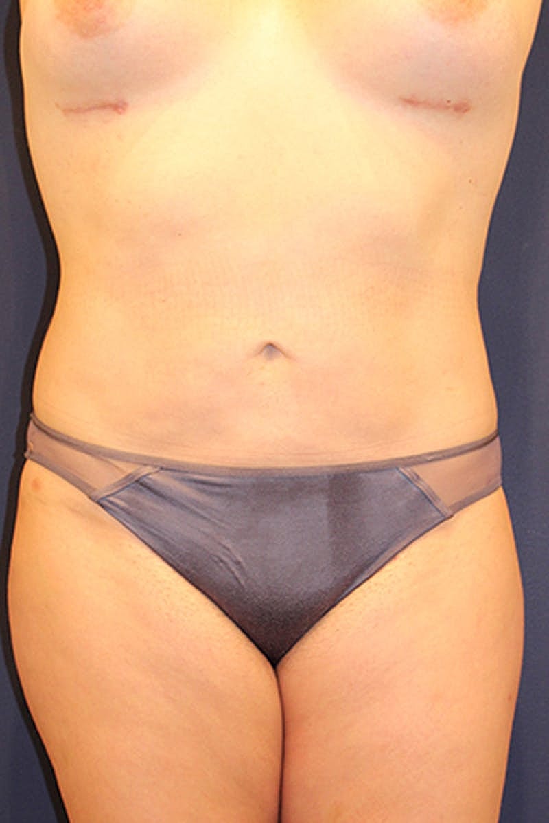Liposuction Before & After