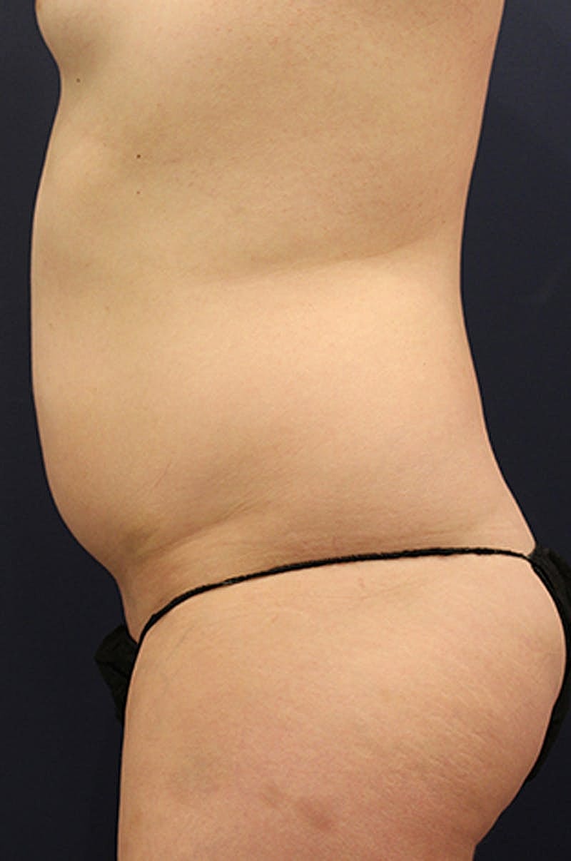 Liposuction Before & After
