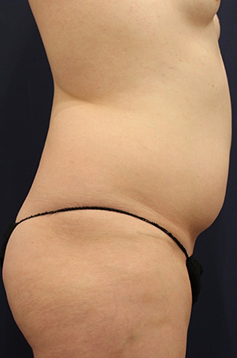 Liposuction Before & After