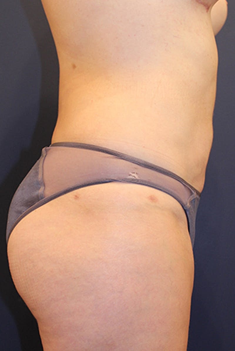 Liposuction Before & After