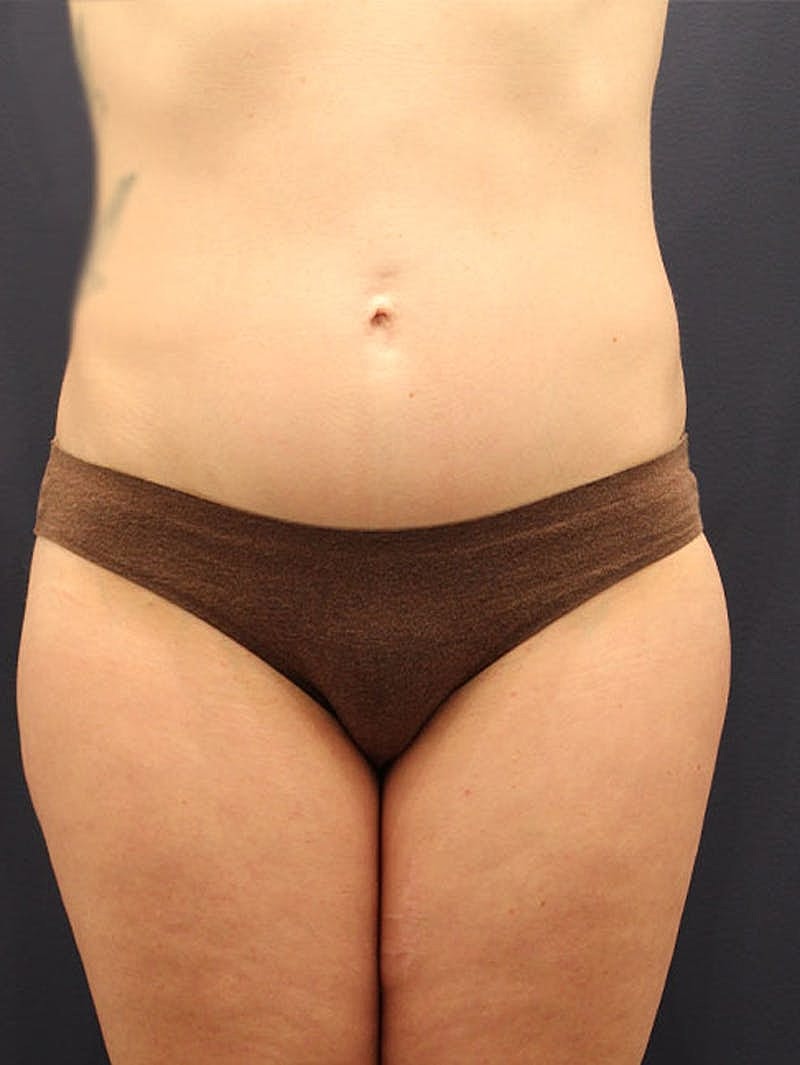 Liposuction Before & After