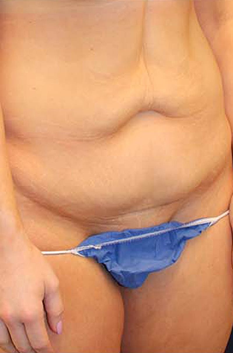 Liposuction Before & After
