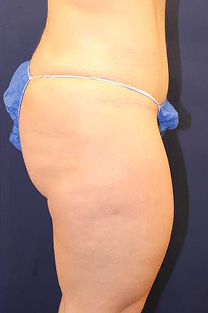 Liposuction Before & After