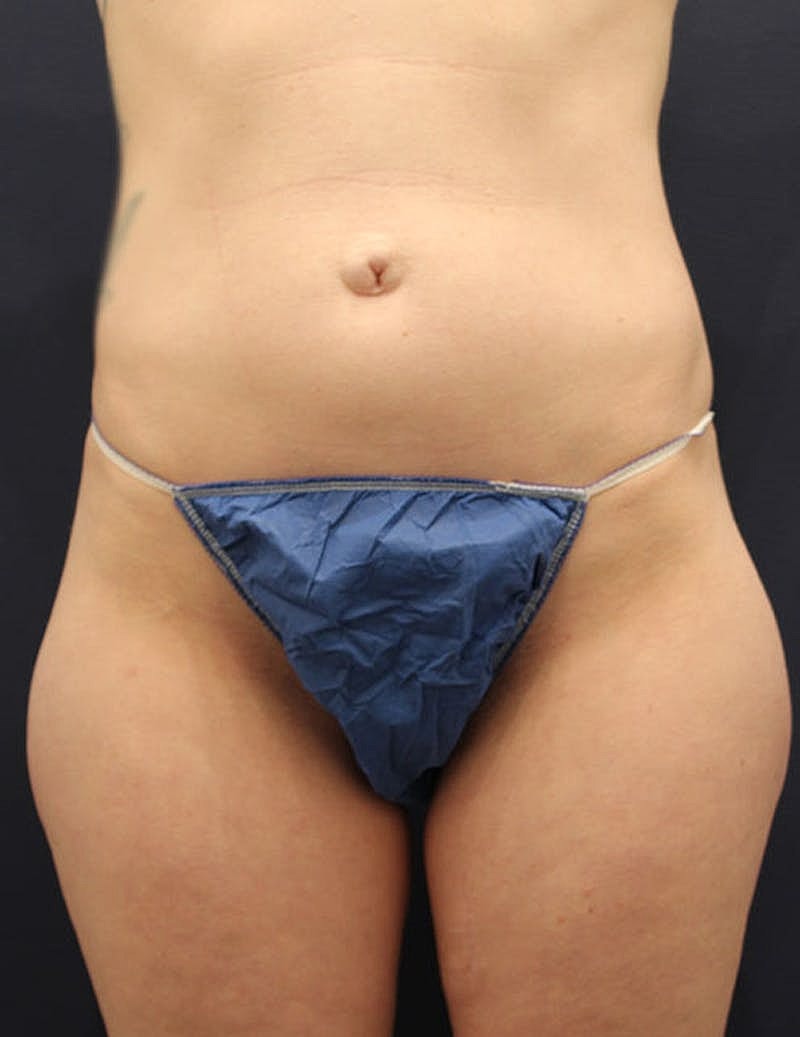 Liposuction Before & After