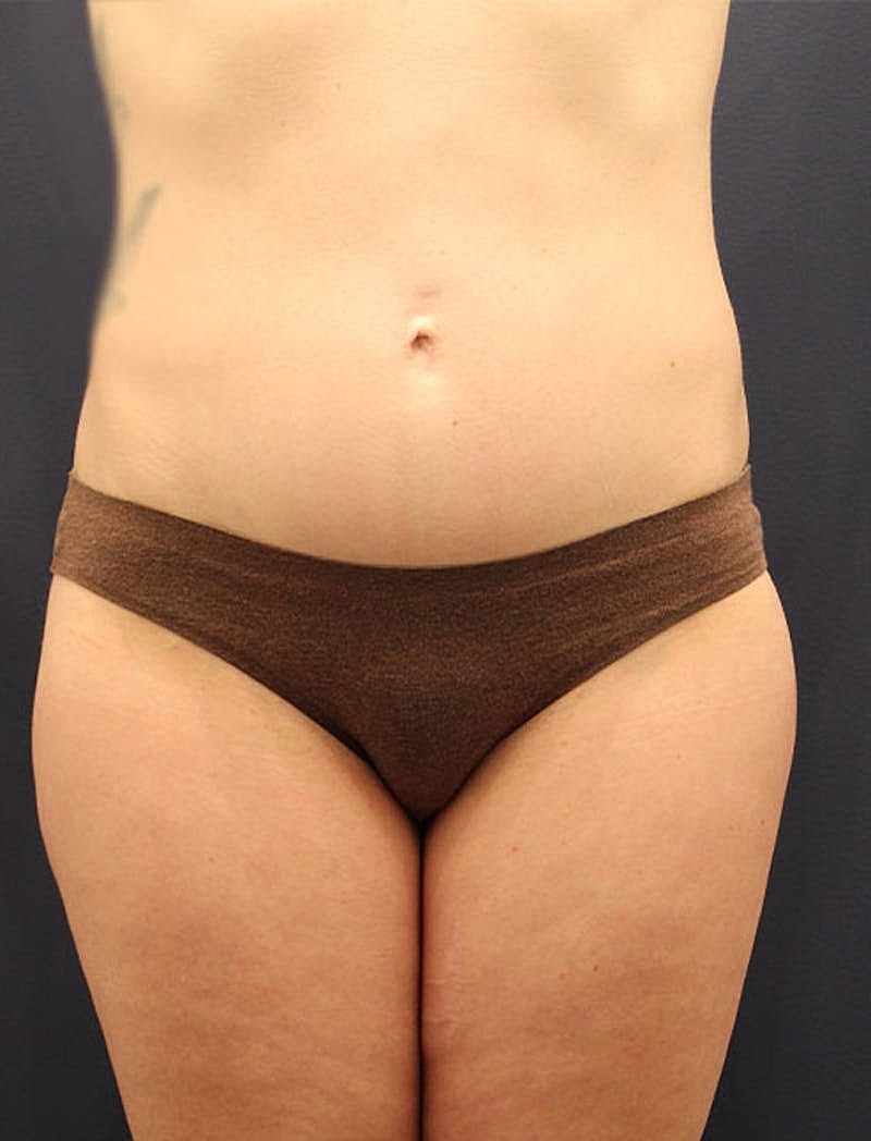 Liposuction Before & After