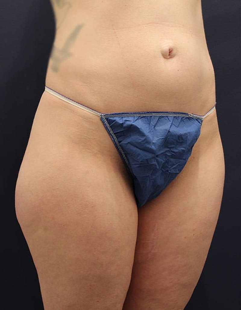Liposuction Before & After