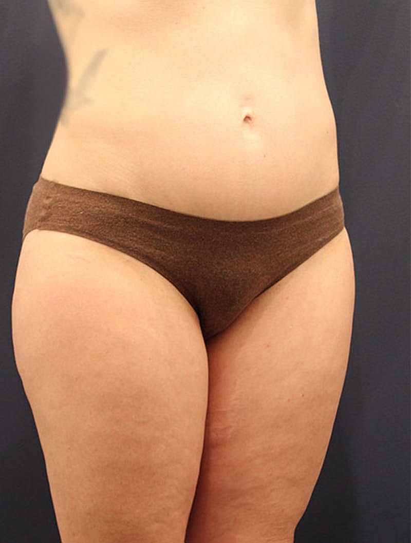 Liposuction Before & After