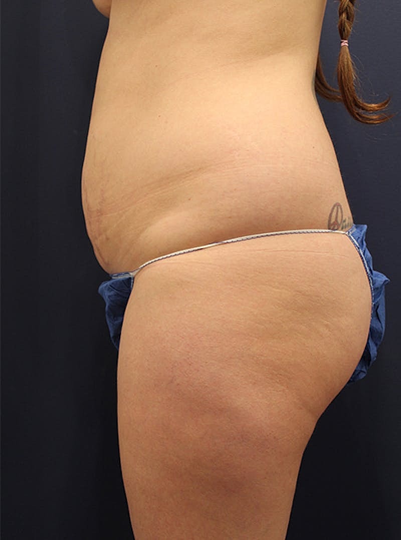 Liposuction Before & After