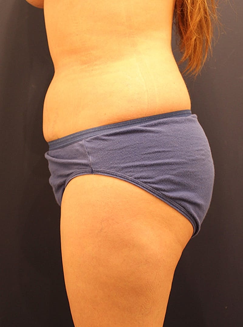 Liposuction Before & After