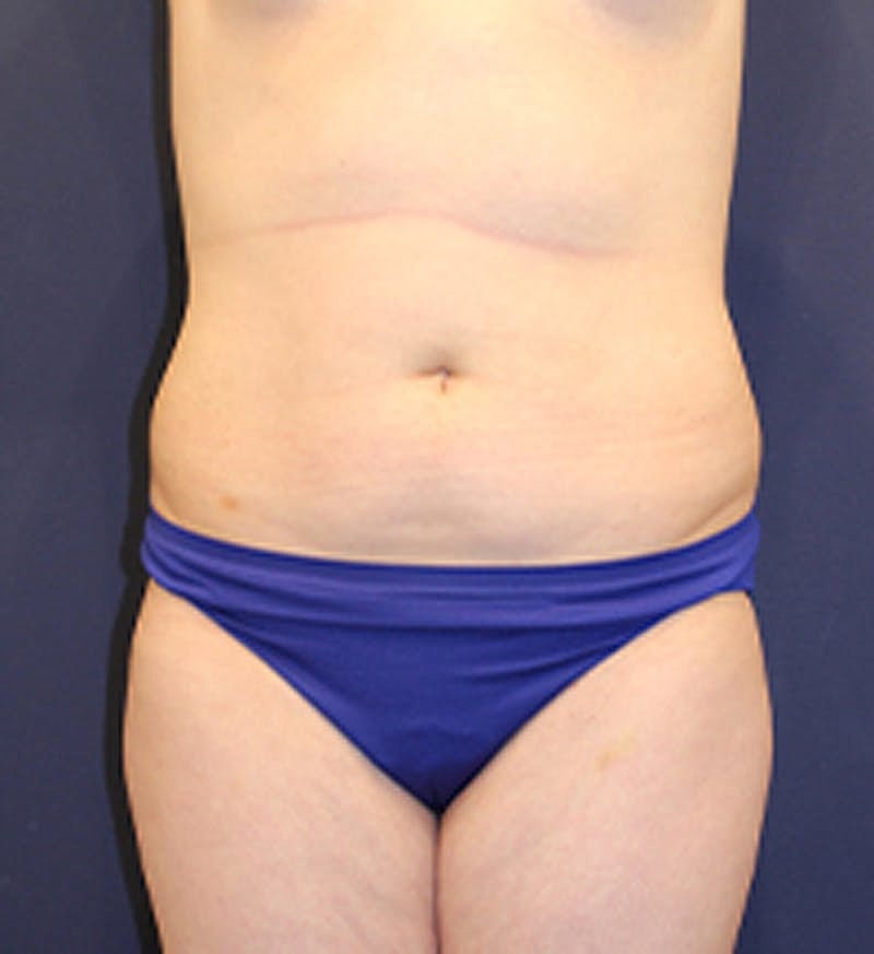 Liposuction Before & After