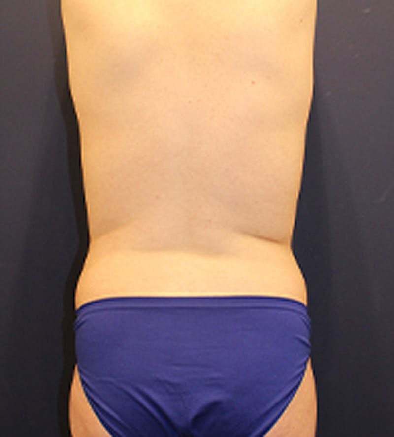 Liposuction Before & After