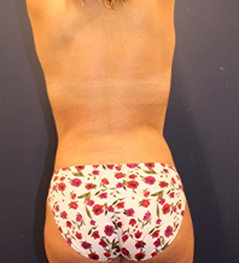 Liposuction Before & After