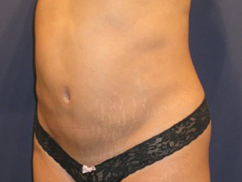 Liposuction Before & After