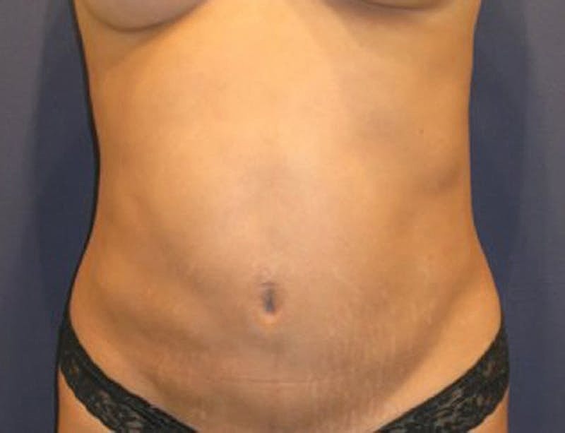 Liposuction Before & After