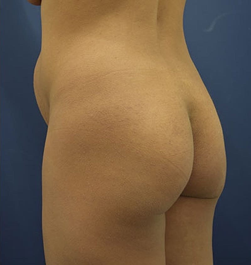 Liposuction Before & After