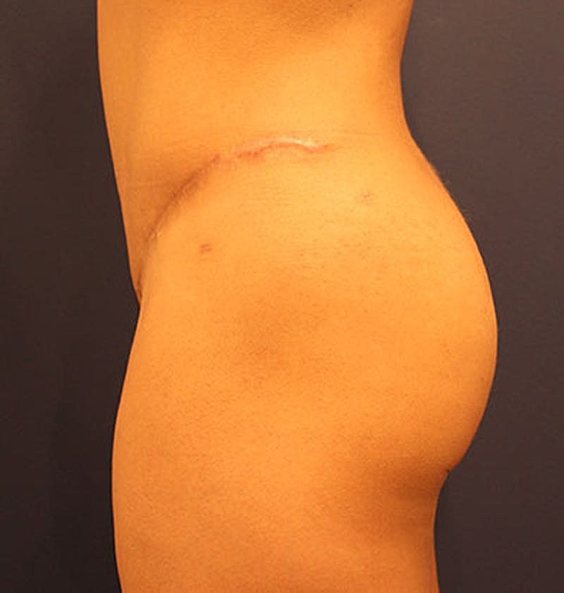Liposuction Before & After