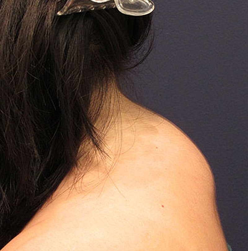 Liposuction Before & After