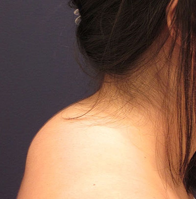 Liposuction Before & After