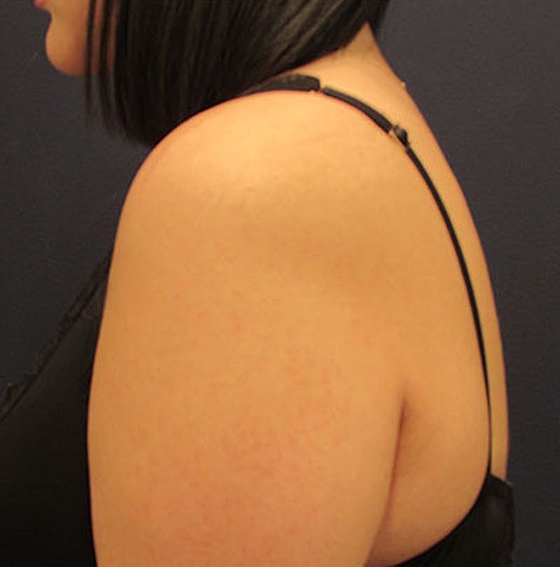 Liposuction Before & After