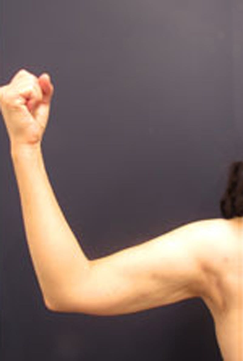 Liposuction Before & After