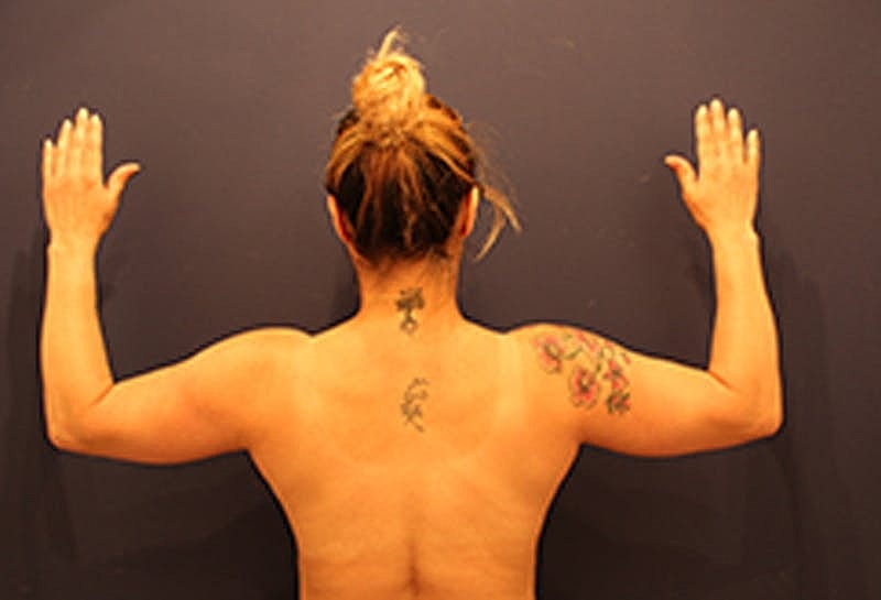 Liposuction Before & After