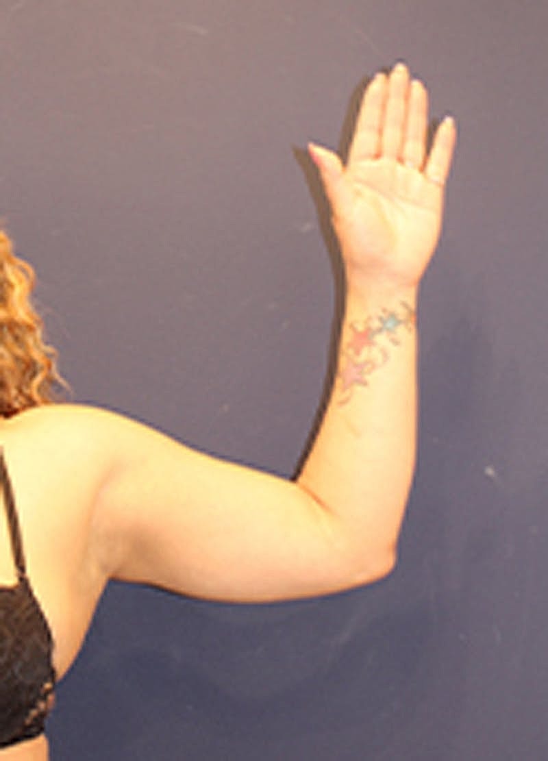 Liposuction Before & After