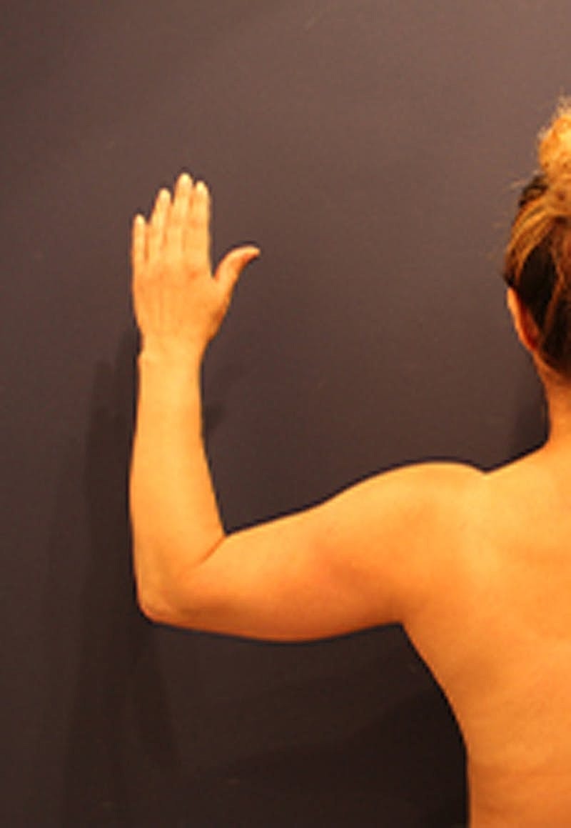 Liposuction Before & After