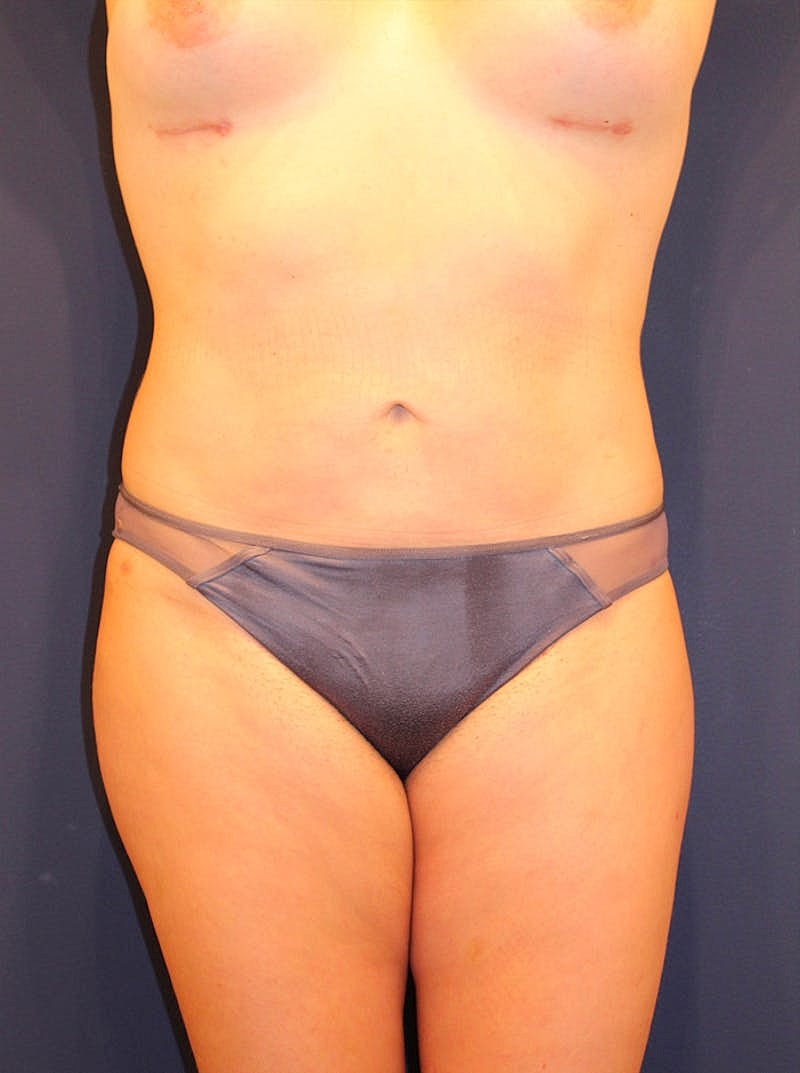 Liposuction Before & After