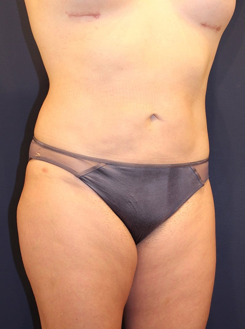 Liposuction Before & After