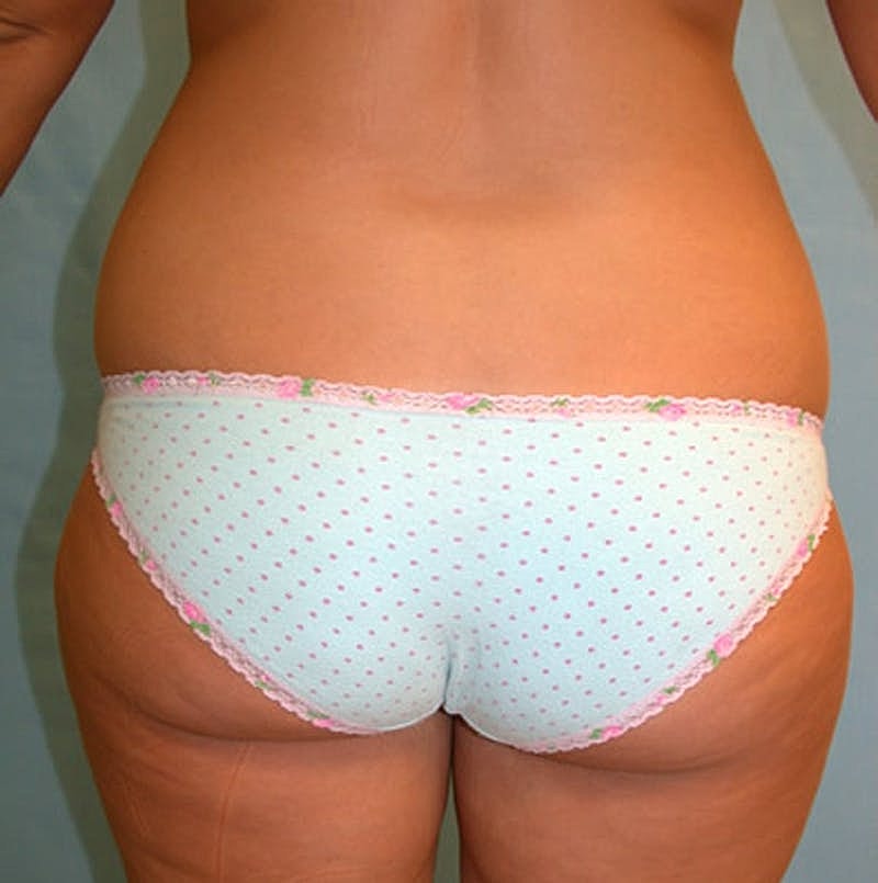 Liposuction Before & After