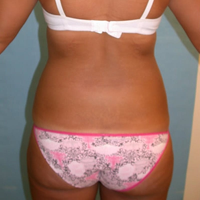 Liposuction Before & After