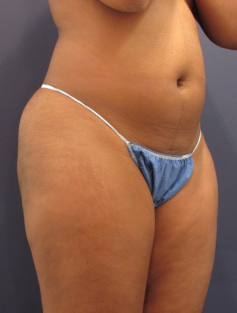 Liposuction Before & After