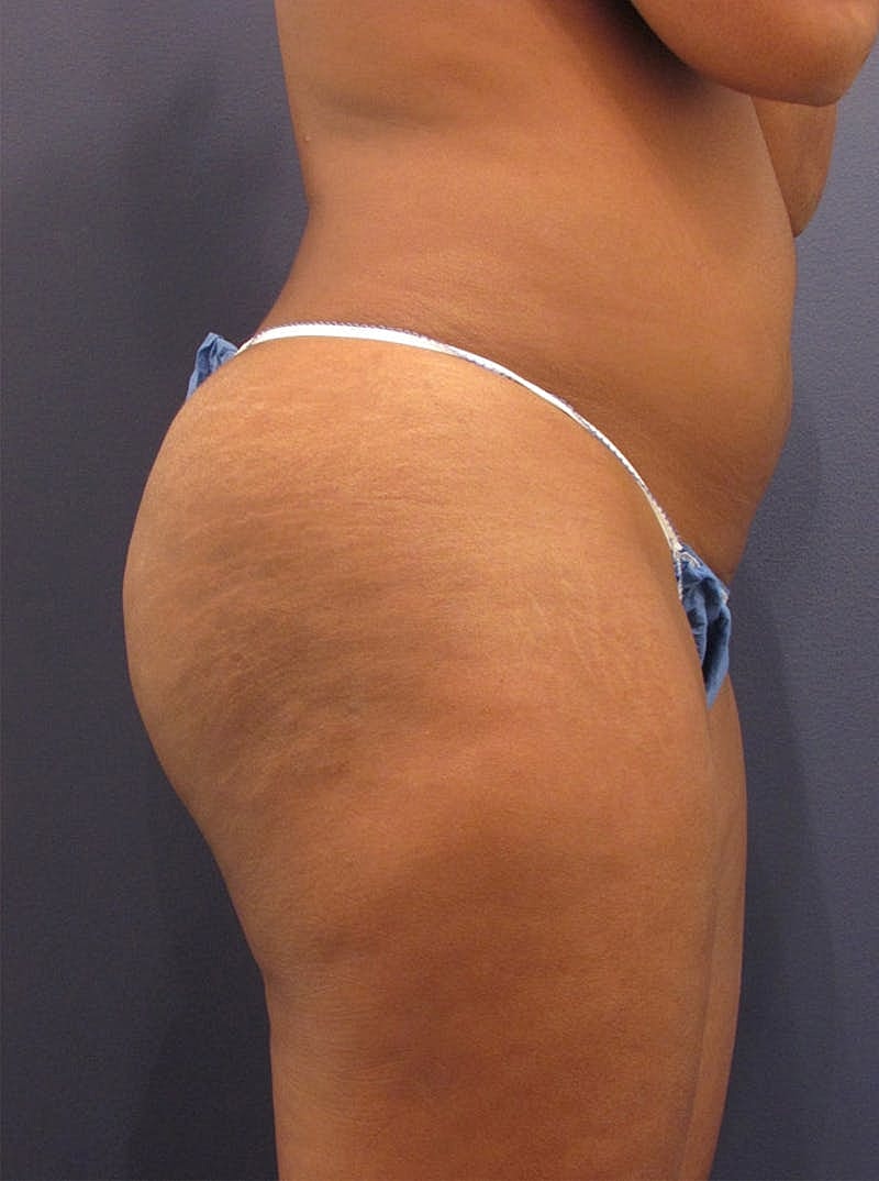 Liposuction Before & After