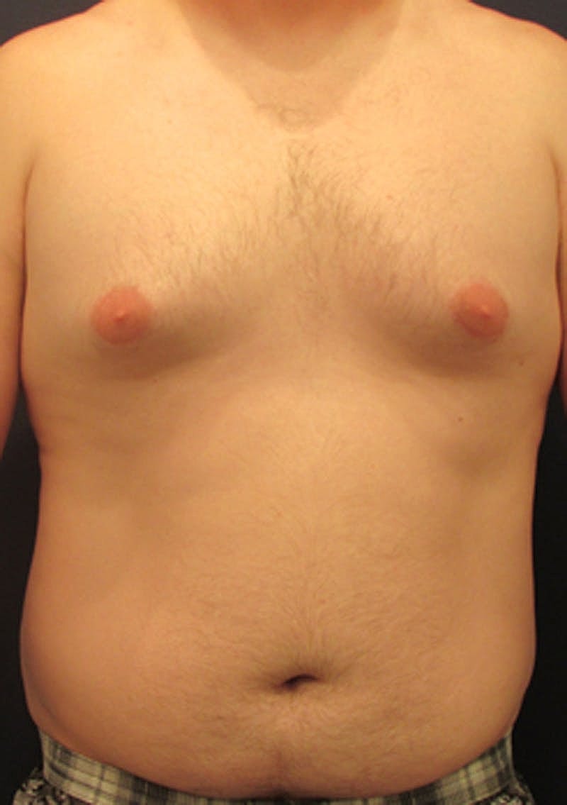 Liposuction Before & After