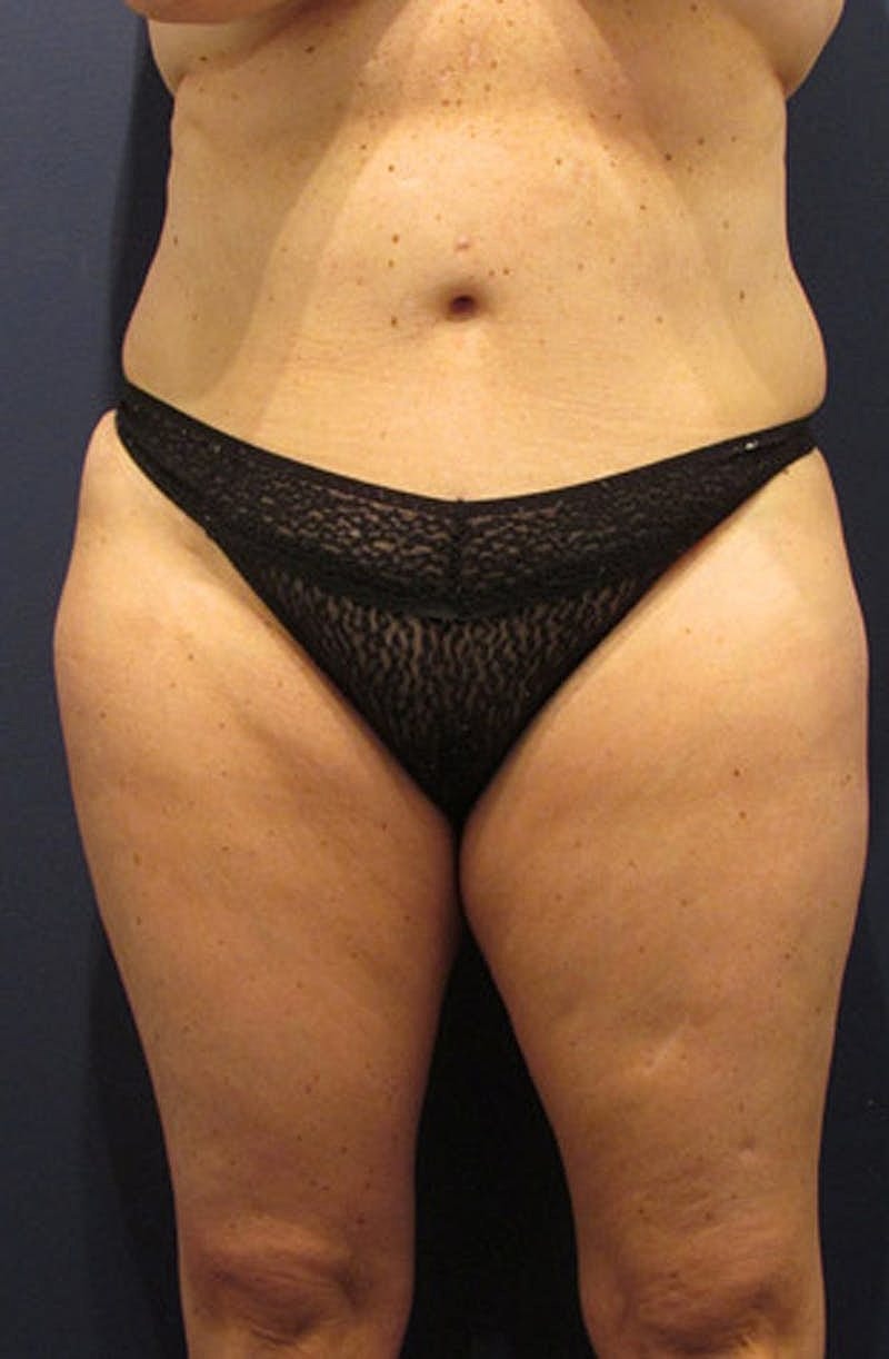 Liposuction Before & After