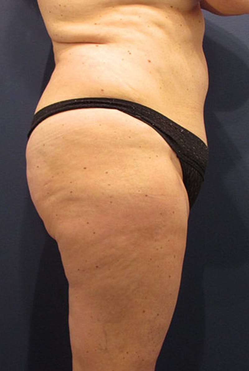 Liposuction Before & After