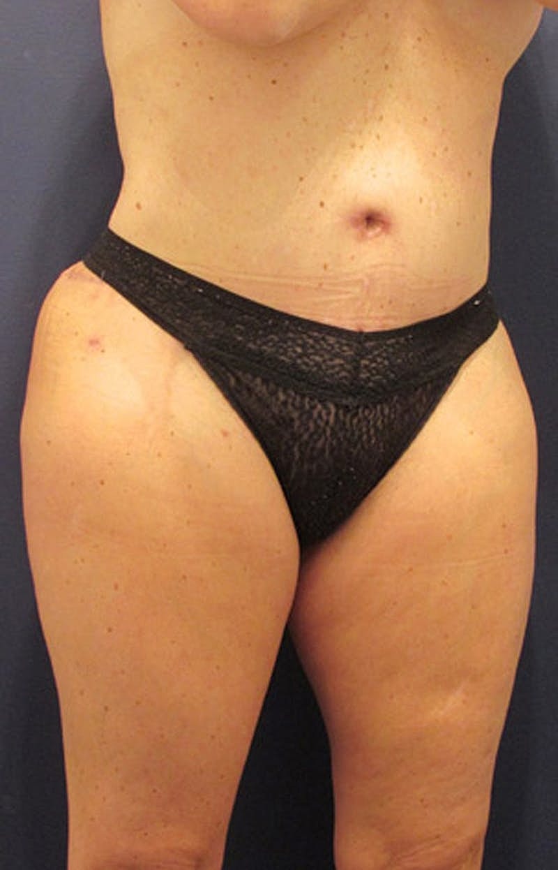 Liposuction Before & After