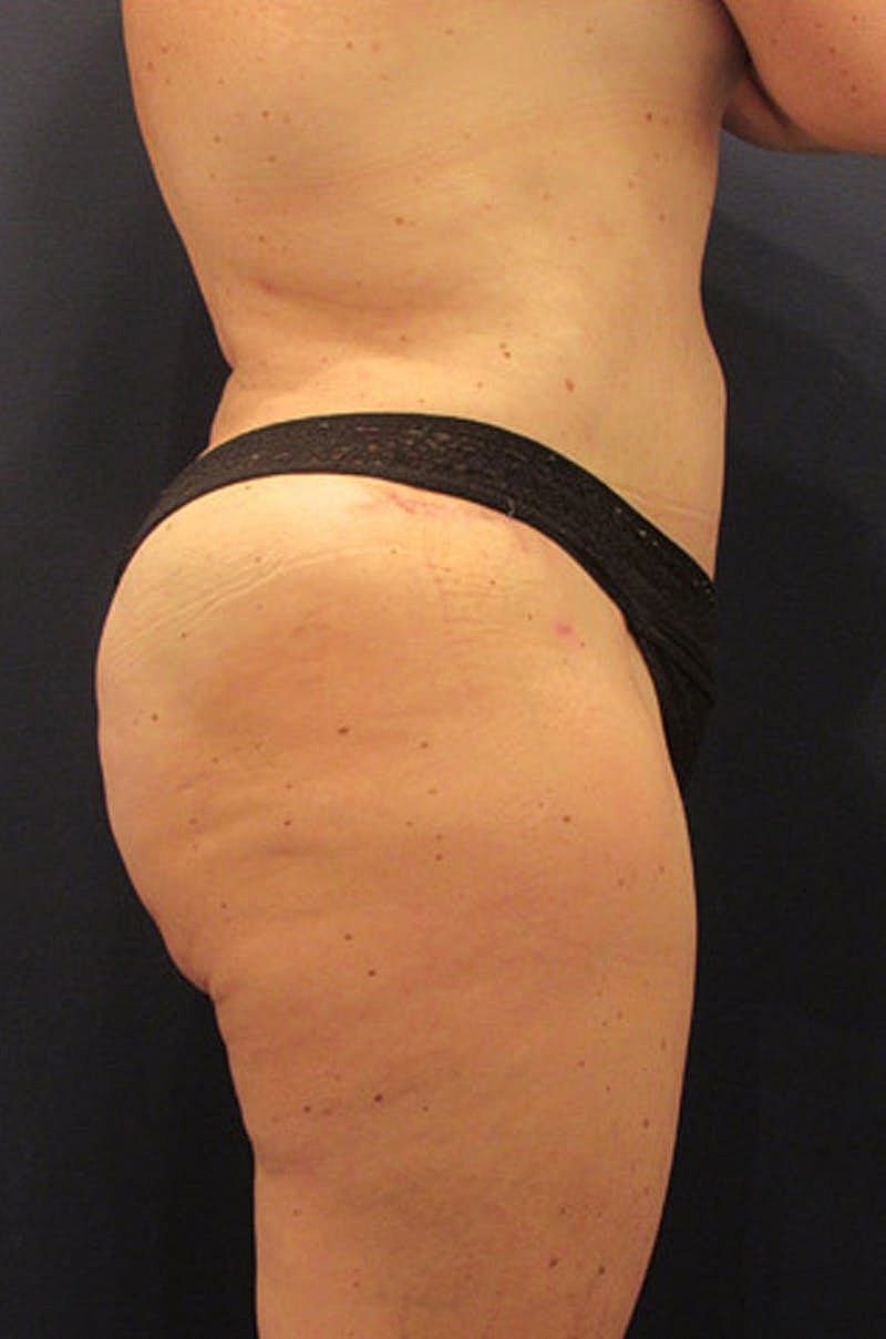 Liposuction Before & After