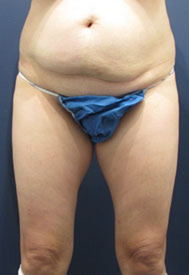 Liposuction Before & After