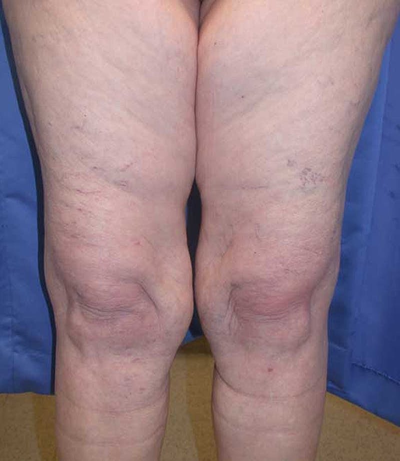 Liposuction Before & After